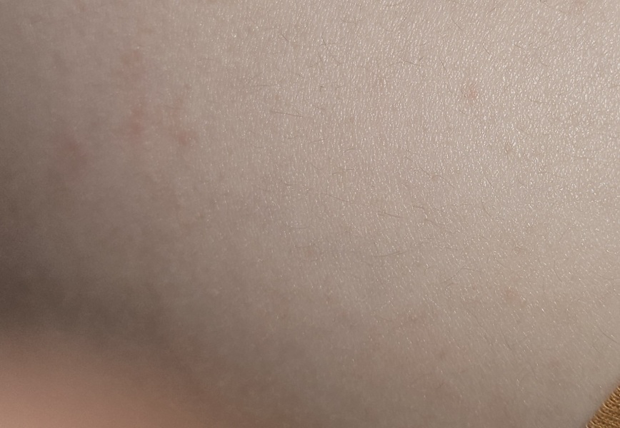 Chickenpox...?