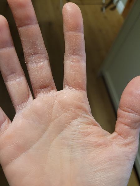 Help me save my scaly hands