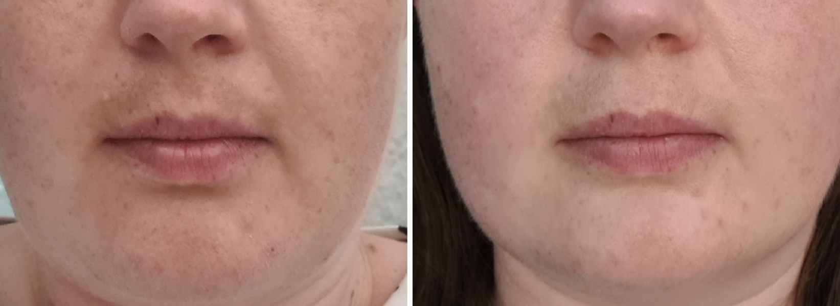 Melasma treatment