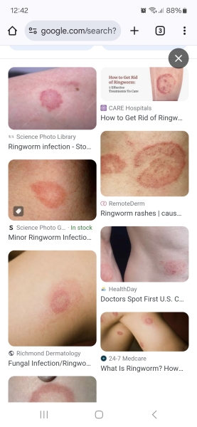 Hand infected (Warning, gross photos)