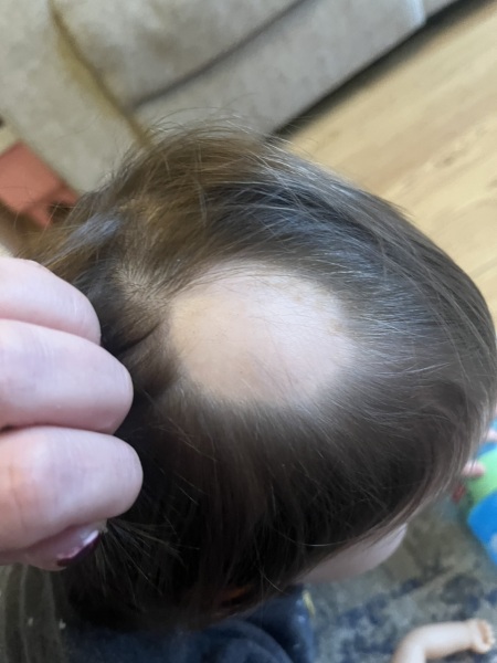 Bald patches on toddlers scalp