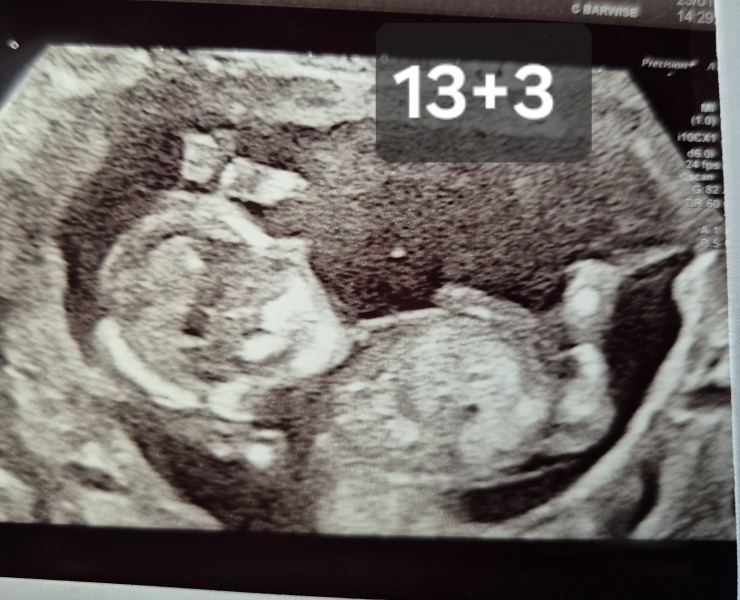 Has anyone had nub theory be wrong?