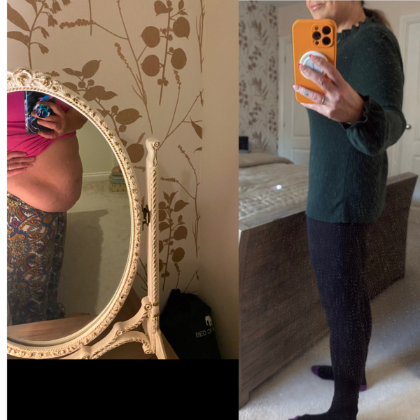 Tummy tuck must haves