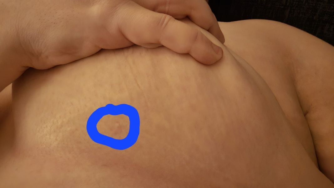 Funny bump on breast