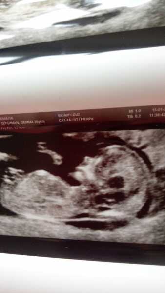 13 week scan