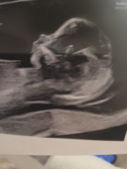 Ultrasound high chance for down syndrome. Please help