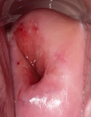 [Sensitive images attached] Warning pls .. sensitive pic..bleeding on cervix