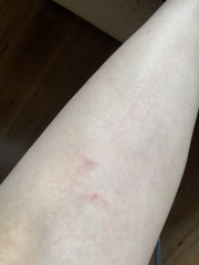 To think these are flea bites?