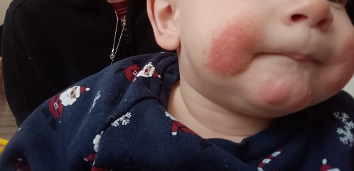 Baby eczema on face