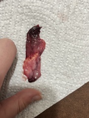 Decidual Cast from potential endometriosis? WARNING pictures