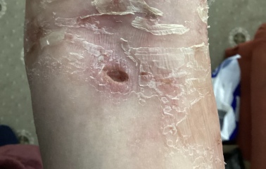 I though you might like these photos were my stitches came out early.