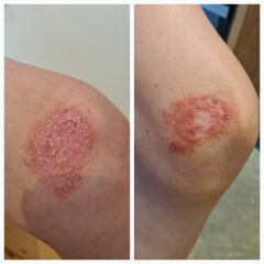 Ringworm  ?