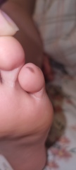 Mark on daughter's toe