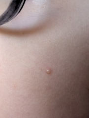 What is this spot on my child? Picture included
