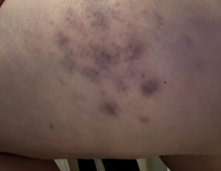 Unexplained Bruising?