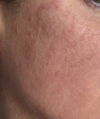 To ask for advice on dermaplaning rash - please help!