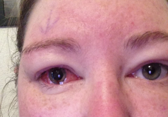 Please tell me about vitrectomy / Pneumatic retinopexy
