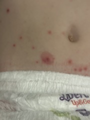 Infected chickenpox?