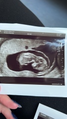 Fluid all around baby - 12 weeks