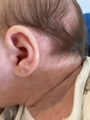 Baby acne or CMPA or something else??