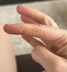 Odd dark lines on fingers