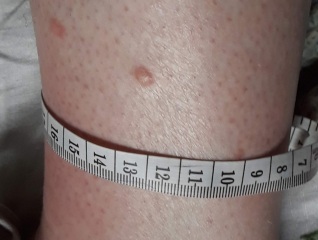 Skin spot - Has anyone had anything that looks like this?