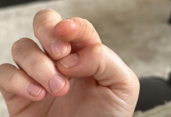 Odd dark lines on fingers