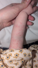 Can you help me identify this rash/spots?