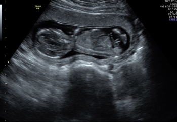 Potty shot 15 weeks