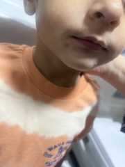 Are these chickenpox?