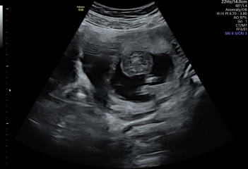 Any Sonographers out there?