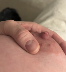 Lump on nipple (pictures included)