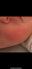 Fifth disease or teething cheeks etc?