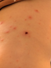 Chicken pox - is this ok?
