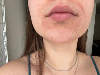 Rash & vomiting.