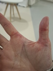 Hand infected (Warning, gross photos)