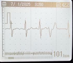 Strange ECG recordings - unsure what to do