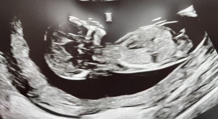 Gender baby