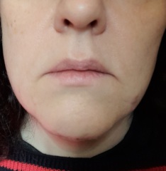 Am I a good facelift candidate?