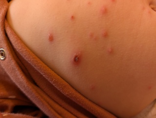 Chicken pox - is this ok?