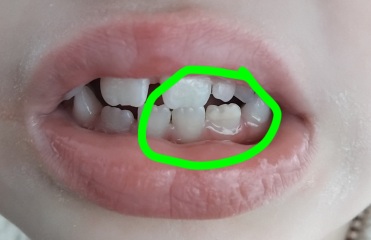 Whats wrong with DS tooth?! (With pic)