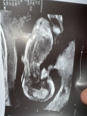Boy or girl