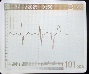 Strange ECG recordings - unsure what to do
