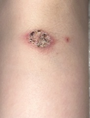 Could this be skin cancer?