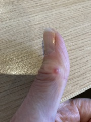 Resistant scabies?