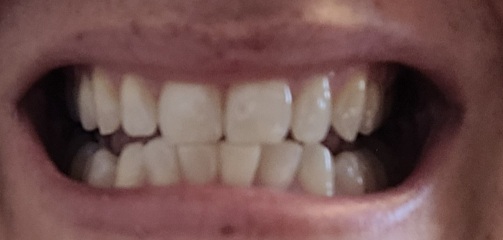 Pics of teeth - bonding or invisalign as well?