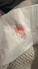 Implantation or period