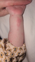 Can you help me identify this rash/spots?