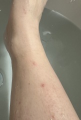 Help- do I have chicken pox??