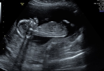 Potty shot 15 weeks